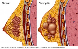 Menya byinshi ku ndwara ya “Fibrocystic Breast Disease” itera benshi kwikanga kanseri